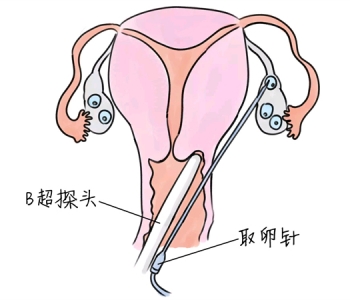 孕检正常 为何迟迟怀不上孩子呢